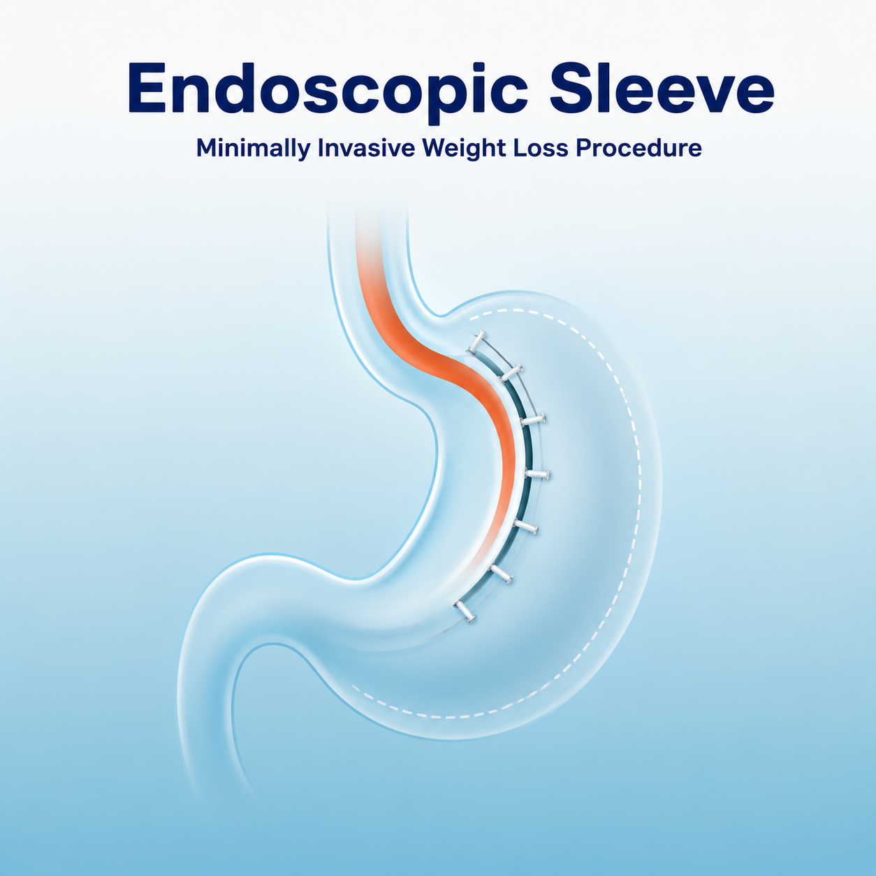 Endoscopic Sleeve (ESG) procedure