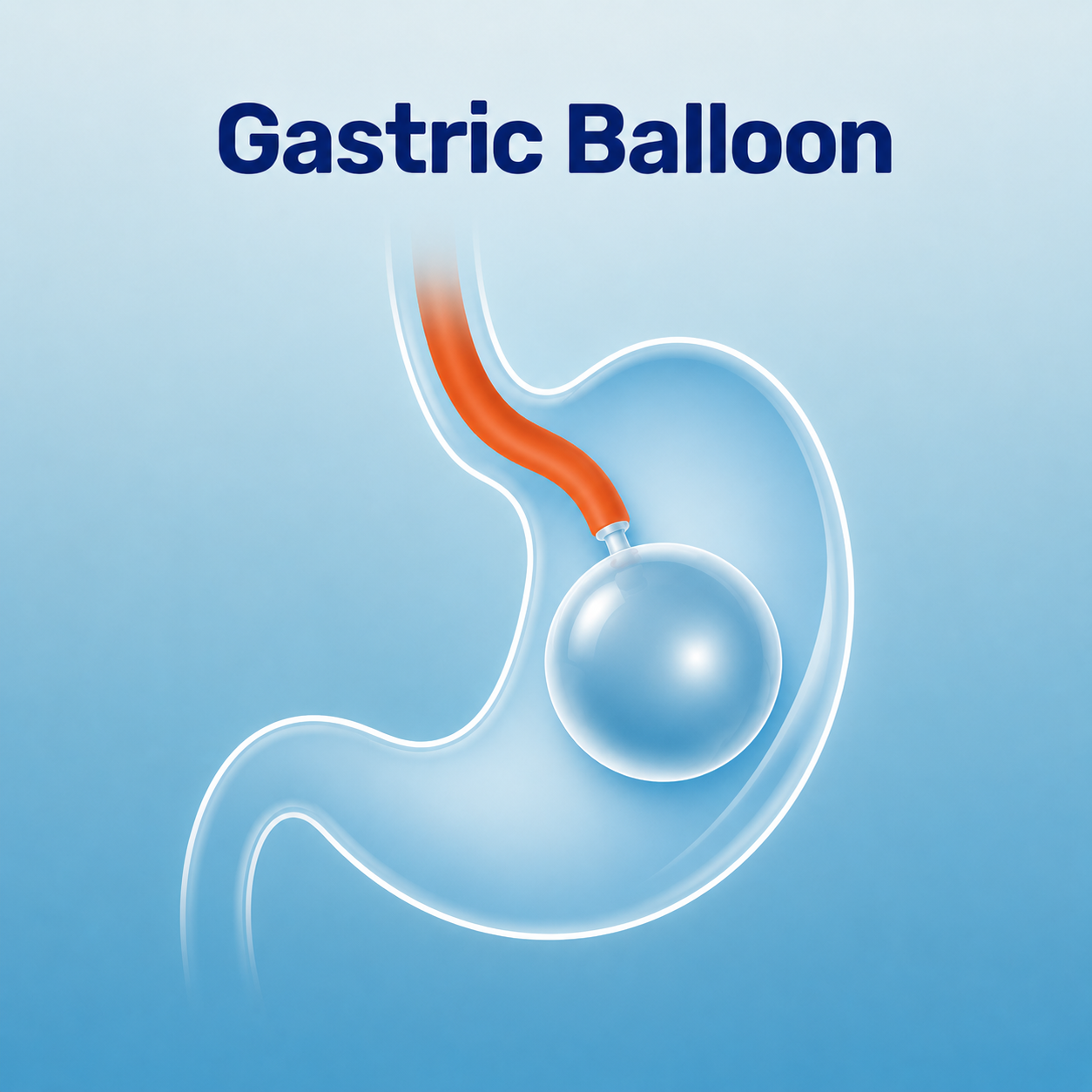 Gastric Balloon procedure