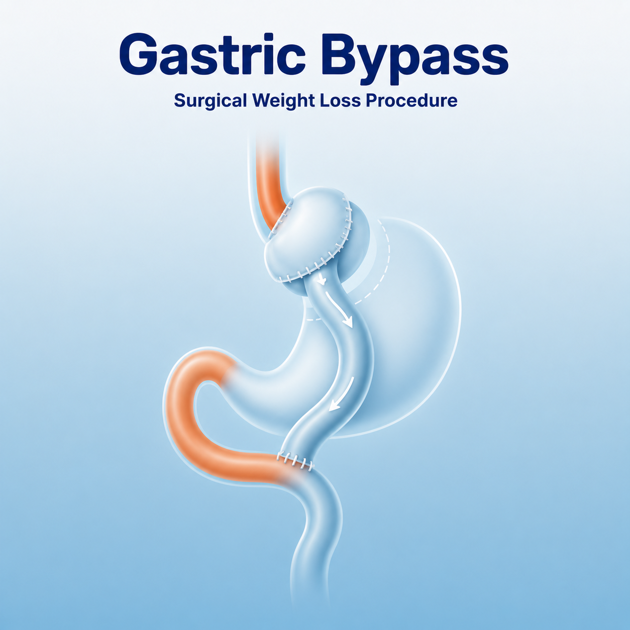 Gastric Bypass procedure