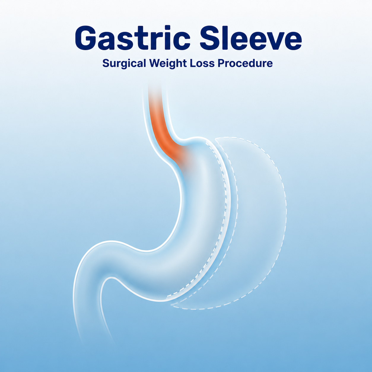 Gastric Sleeve procedure